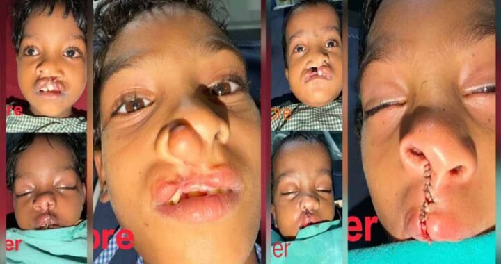 चिरायु योजना से जन्मजात समस्या से मिली राहत, तीन बच्चों के चेहरों पर लौटी मुस्कान